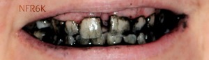 charcoal teeth 1